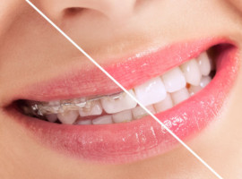 Pre-Restoritive Orthodontics